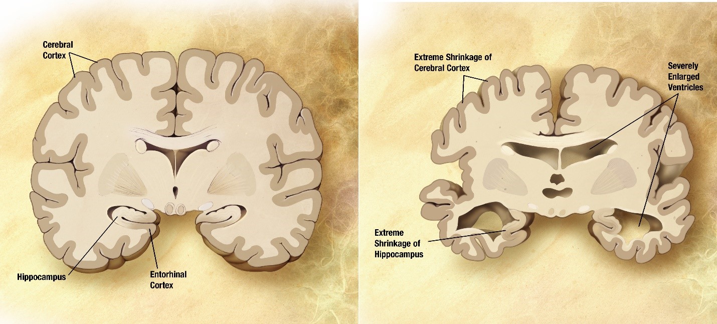 Obesity and the brain